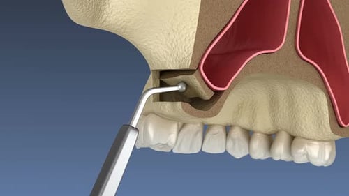 Cirugía de lifting sinusal con acceso lateral. Animación 3D de una cirugía dental