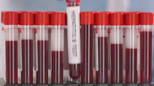 Hepatitis B Blood Test Sample in Rack