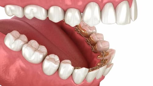 Animated Lingual Braces Correcting Malocclusion in Human Jaw