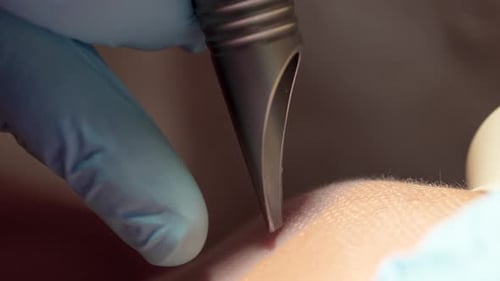 close-up of a laser treatment procedure on skin, where a handheld laser device, guided by a professi