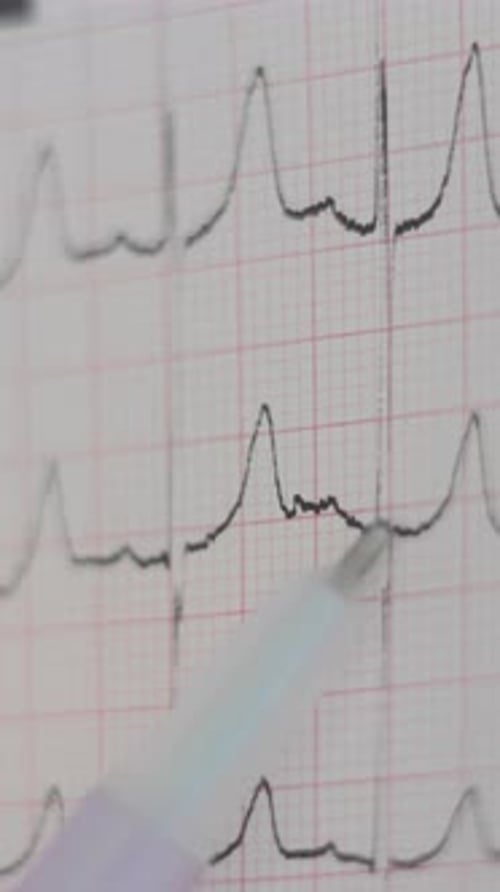 Electrocardiogram