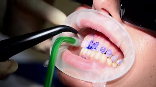 Woman at Dental Chair in Dental Clinic Dental Extreme Close Up Macro Video Cleaning Process in