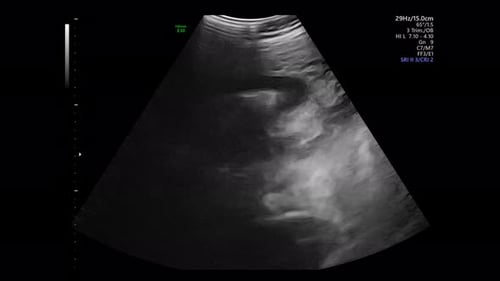 Tiny Female Baby Rolls Over in Mother's Abdomen