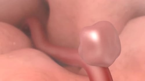 Animated Brain Hemorrhage from Skull Fracture Medical