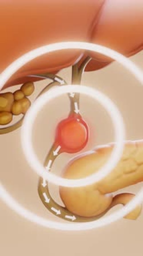 Conceptual 3D animation of a gallbladder stone in vertical format