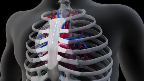 Heart Bypass Surgery