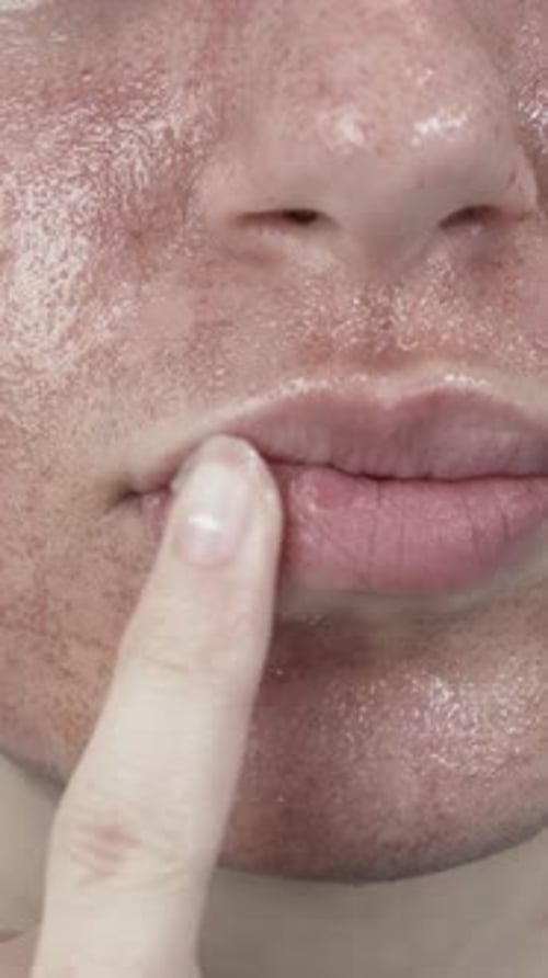 Face Scar Woman Close Up Applying Cream Scars Removal Vertical