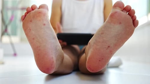 Entérovirus (jambe, bras, bouche)