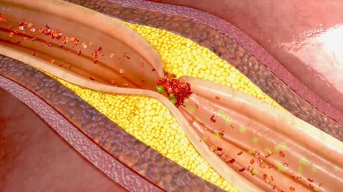 Human artery showing plaque buildup blockage