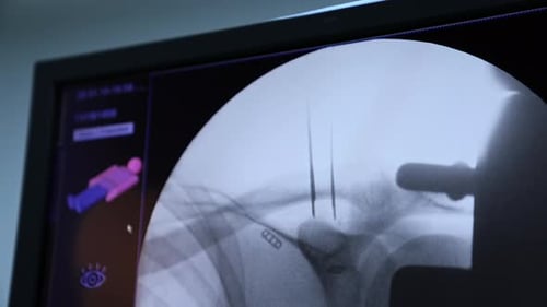 Black and white screen with x-ray shot. Equipment in modern surgical room. Close up.