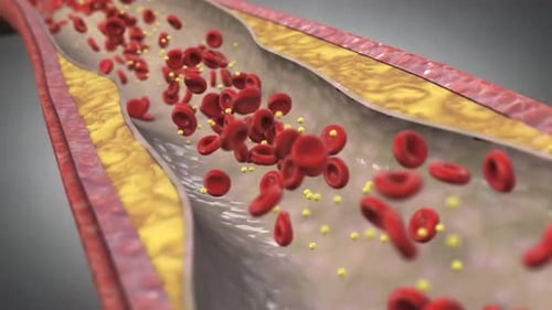 Medical 3d visualization showing a narrowed human artery with plaque buildup
