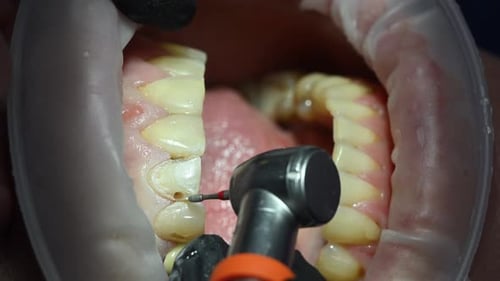 Dental Extreme Close Up Macro Video Dentist Treat Patient Teeth Dental Internist Works with an