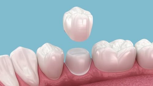 3D Dental Crown Placement Animation for Medical and Healthcare