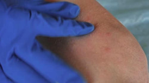 Arzt untersucht Teenager-Mädchen mit körperlichem roten Hautausschlag Allergie Nahaufnahme Teenager kratzt Eruption Krankenschwester