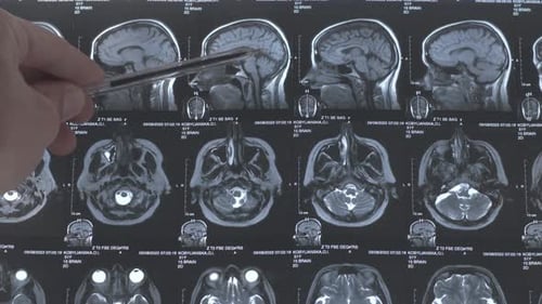 CT scan of human brain