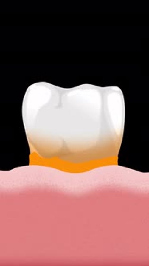 Animated Medical Illustration of Plaque Formation on a Tooth