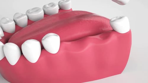 3D Dental Implant Installation and Restoration Animation