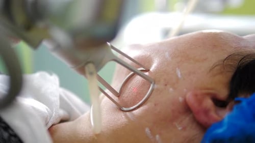 Fractional Laser CO2 Procedure Cosmetic Treatment in Beauty Clinic Woman Having Laser Skin Treatment