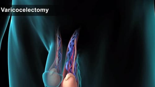 Varicocelectomy Surgical Procedure 3D Medical Animation