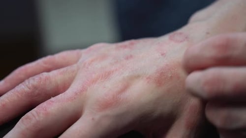 Nahaufnahme einer Frau kratzt sich an der Hand mit einer allergischen Reaktion auf einen roten Psoriasisfleck