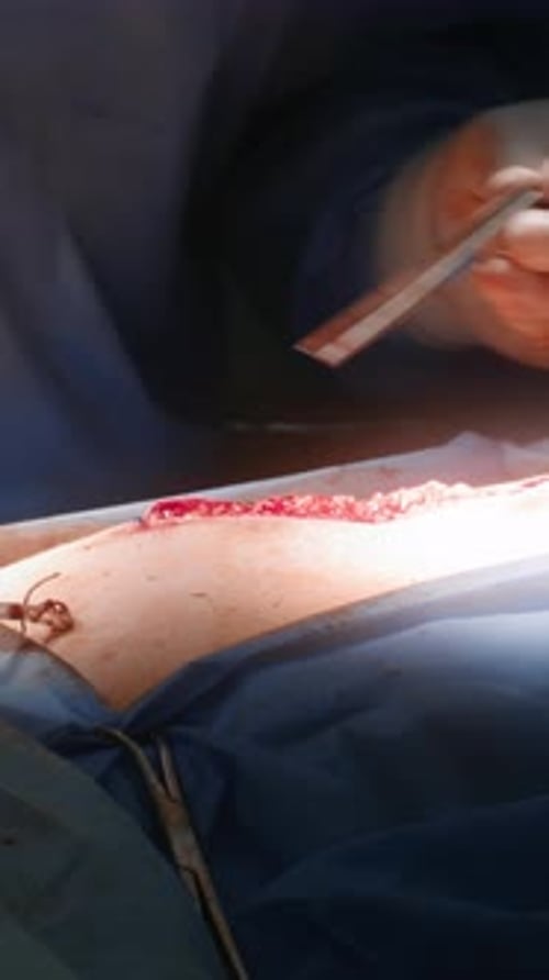 Professional Medic Finishes Long Operation in Operating Room