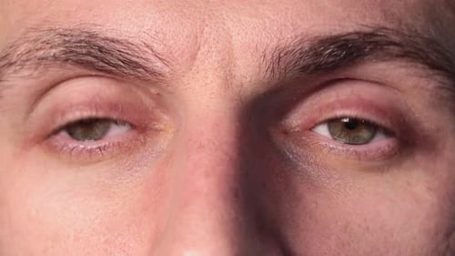 Dry Eye Syndrome