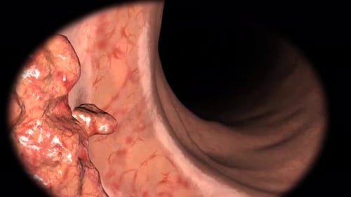 Close-up view of colonoscopy procedure with endoscope