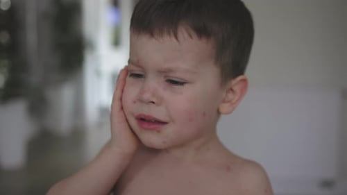Child Rubs Sore Face with Red Spots