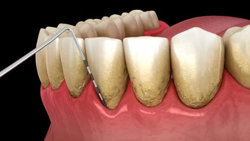 Periodontal Pocket Measurement and Disease Progression 3D Animation