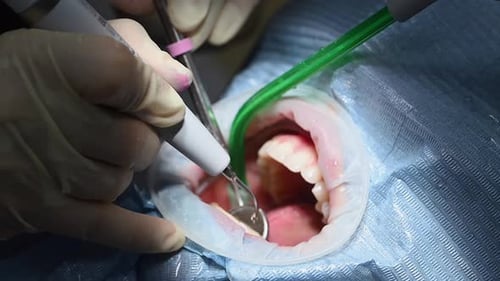 Dental Extreme Close Up Macro Video Cleaning Process in Patient's Mouth Clean Teeth with Water Jet