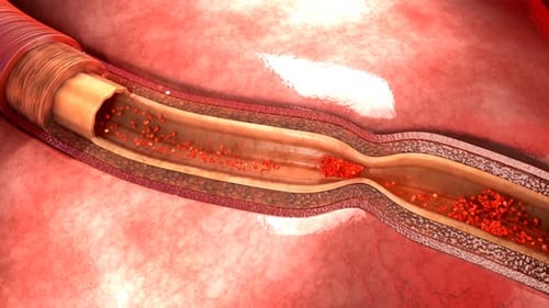Human artery with plaque causing blood clot formation
