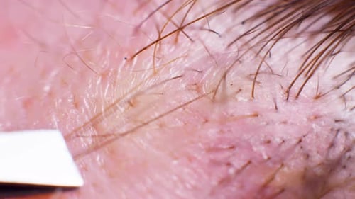 4K Super macro shot of hair removal with tweezers, on a caucasian person, at an extreme close up, in