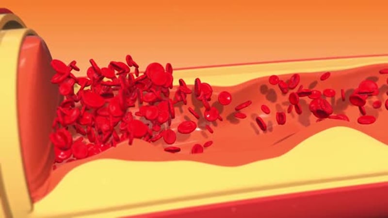 Cholesterol Plaque Formation and Breakdown in Artery Medical Animation ...
