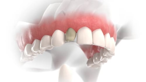 3D Animation of Dental Crown Replacement Procedure