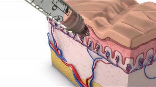 Medical 3D Animation of Dermal Filler Injection in Skin Layers