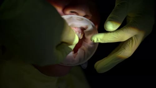 Slow motion of a dentist wearing green gloves placing ceramic composite veneers on top of the inciso