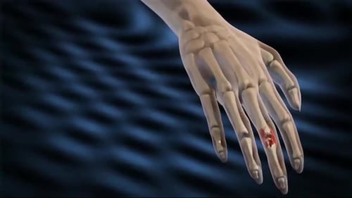 3D Human Hand Joint Degeneration Medical Animation