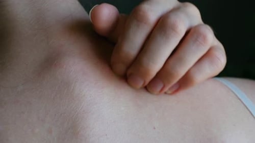 Woman with Itchy Skin Scratching Neck and Shoulder