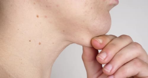 Fat on Woman Chin Saggy Skin in Face