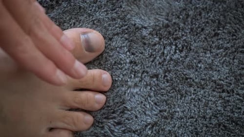 Injured Foot with Bruised Toenail