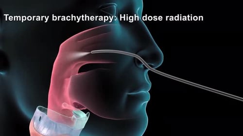 Temporary Brachytherapy for Lung Tumor Treatment