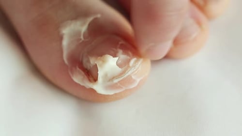 Cream Applied to Discolored Toenail