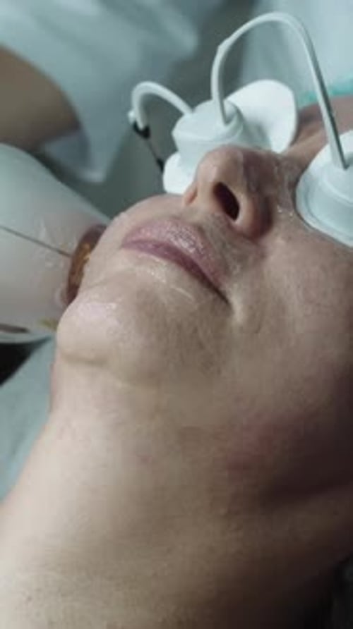 HIFU Treatment for Adult Woman