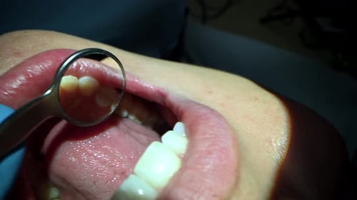 Dental Care Extreme Close Up Macro Video Dentist Treat Patient Teeth Orthodontist Works with