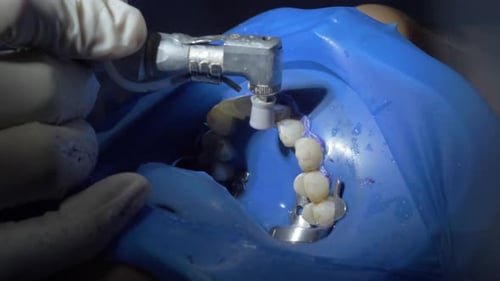 Polishing teeth with a polisher. The final step after the mechanical removal of tartar deposits and