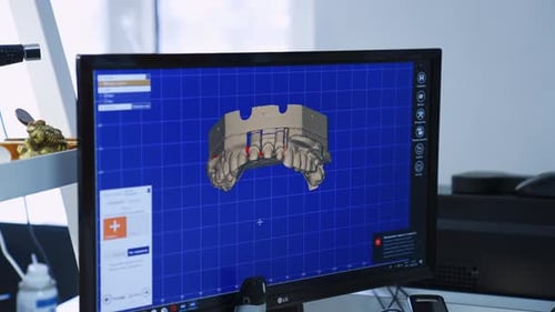 Computer screen with 3d denture scan. Preparation for front teeth implantation. Close up.