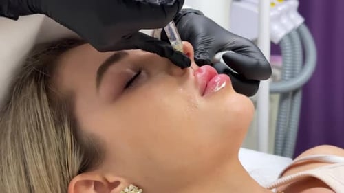 Lip Filler Injection for Beautiful Results