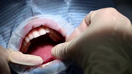 Dental Extreme Close Up Makro Video Reinigungsprozess im Mund des Patienten Zähne mit Wasserstrahl reinigen