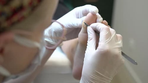 Podiatrist Treating Corn on Patient's Foot Close Up