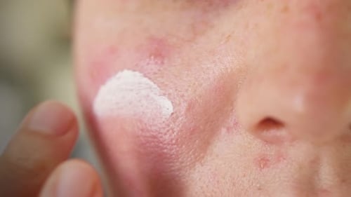 Applying Acne Cream to Face Close Up